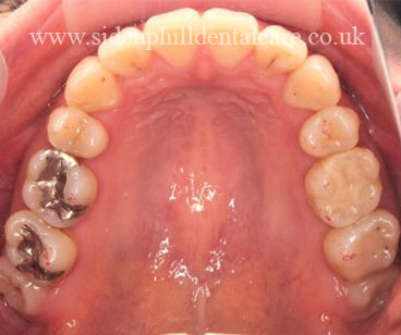 After Invisalign Treatment