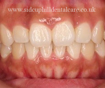 After Invisalign Treatment