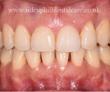 After Invisalign Treatment