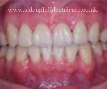 After Invisalign Treatment