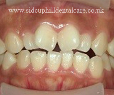 Before Invisalign Treatment