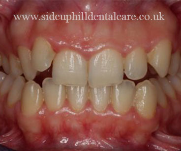 Before Invisalign Treatment