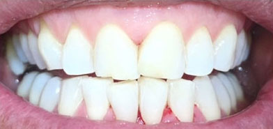 After air polish treatment