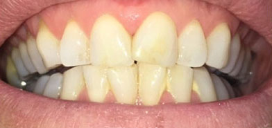 Before air polish treatment