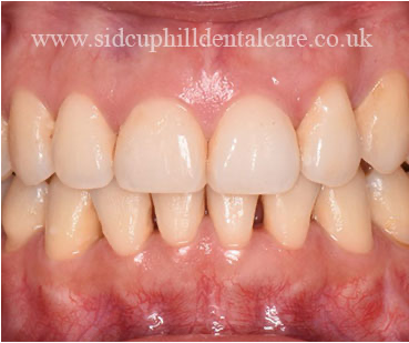 After Invisalign