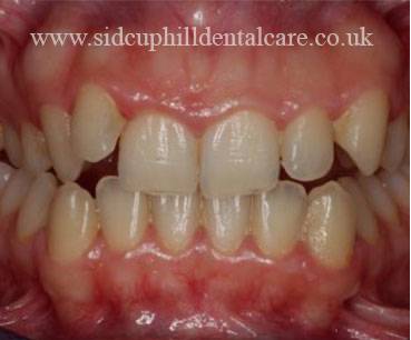 Before Invisalign