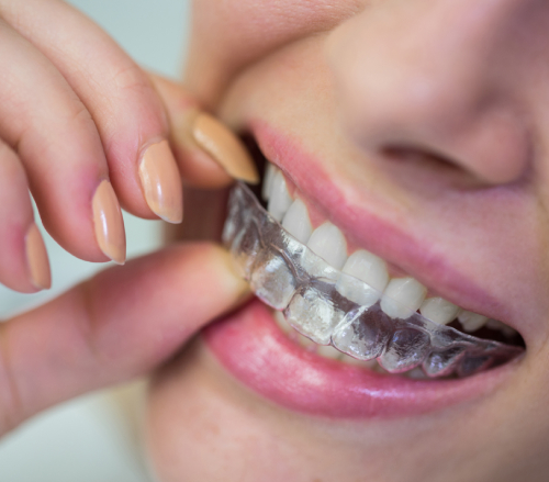 Clear Aligners