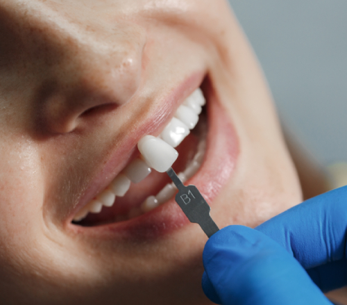 Dental Implants