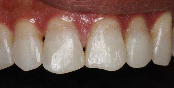 BEFORE treatment
