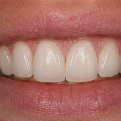 AFTER treatment