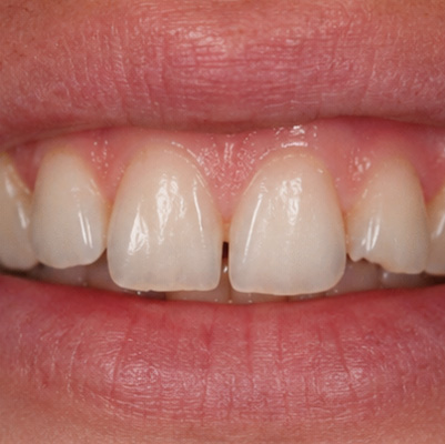 BEFORE treatment