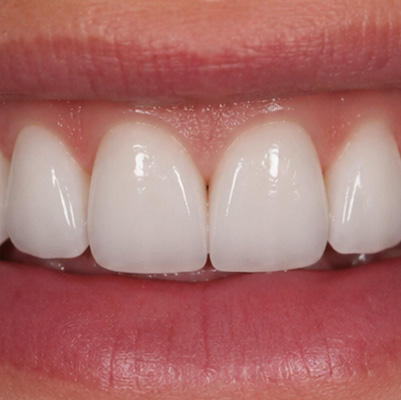 AFTER treatment