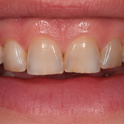 BEFORE treatment